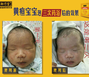 御療堂藥浴黃疸6